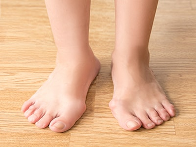 Treat Your Bunions without Surgery