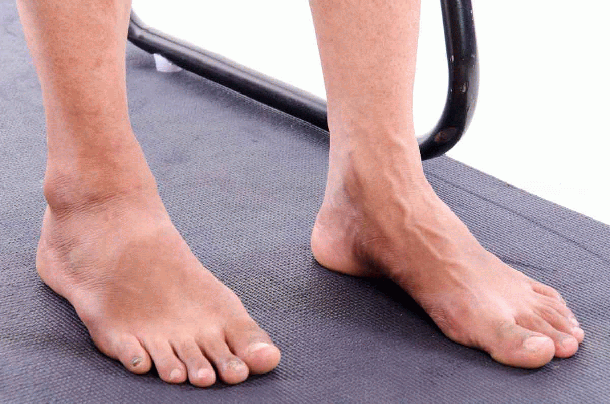 Toe Extension Vissco Healthcare Private Limited Toe Extension Vissco Healthcare Private Limited